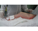 Использование лазера при варикозной болезни вен нижних конечностей (ЭВЛК)